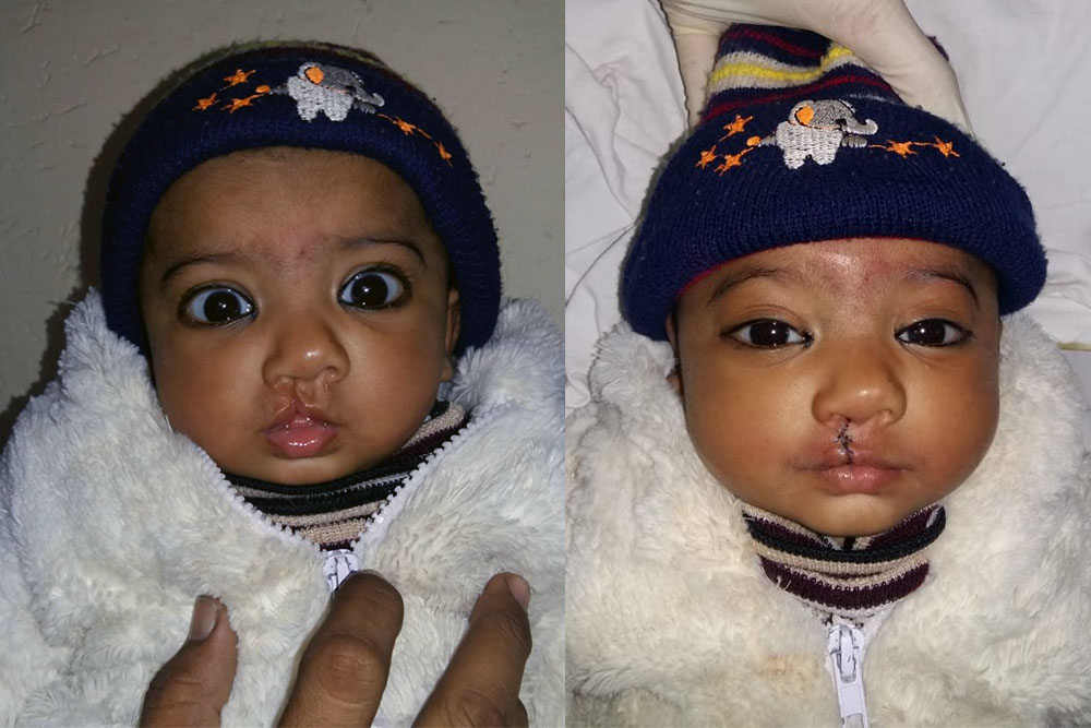 Before and after cleft surgery