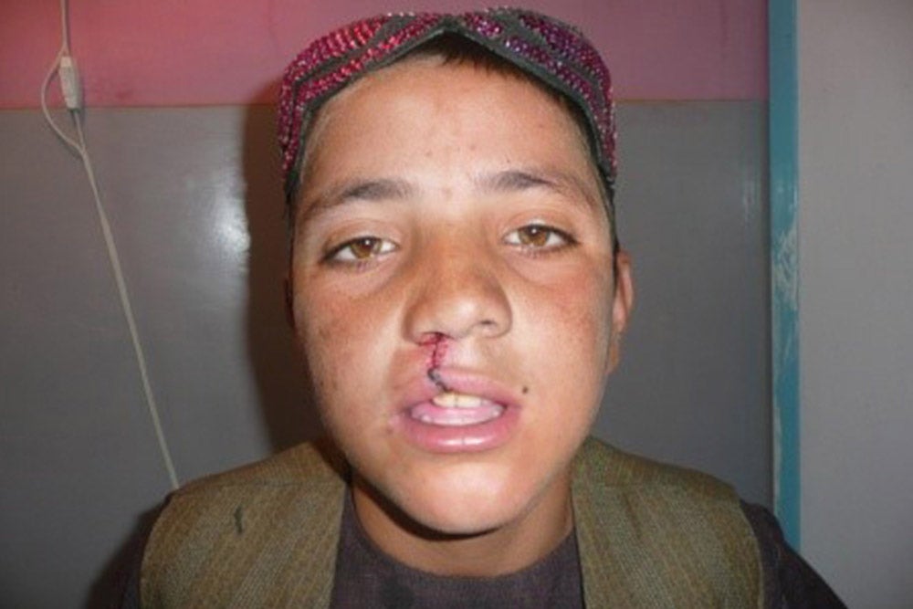 Hekmatullah after cleft surgery