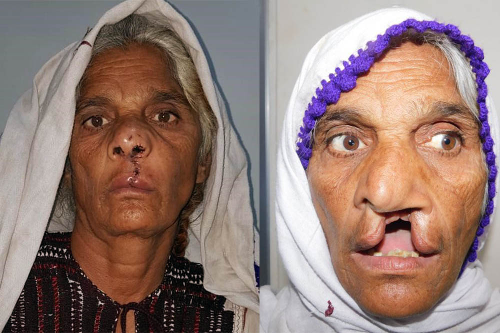 Pyari before and after cleft surgery