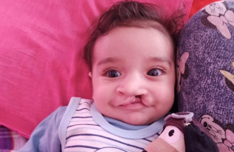 Malek before cleft surgery
