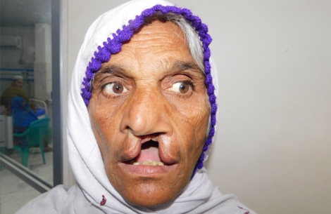 Pyari before cleft surgery