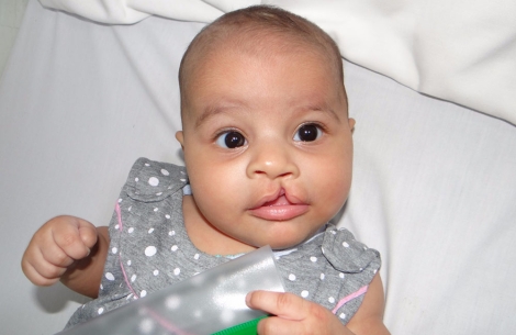 Roaa before cleft surgery