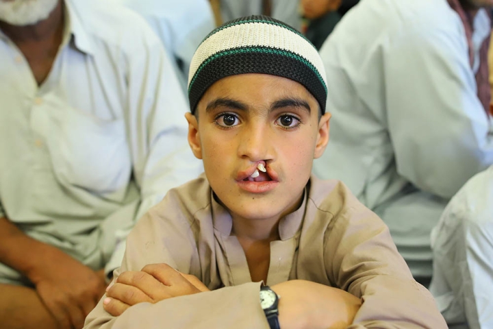 young man waits for cleft surgery