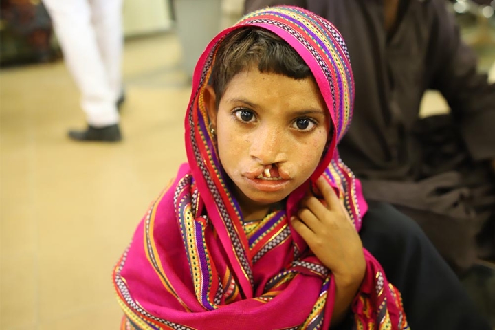 Child with cleft from Pakistan