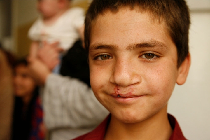 boy after cleft lip surgery smiles