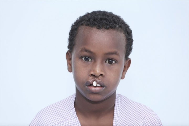 Abdirashid before cleft surgery