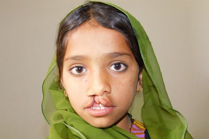 Child with cleft from Pakistan