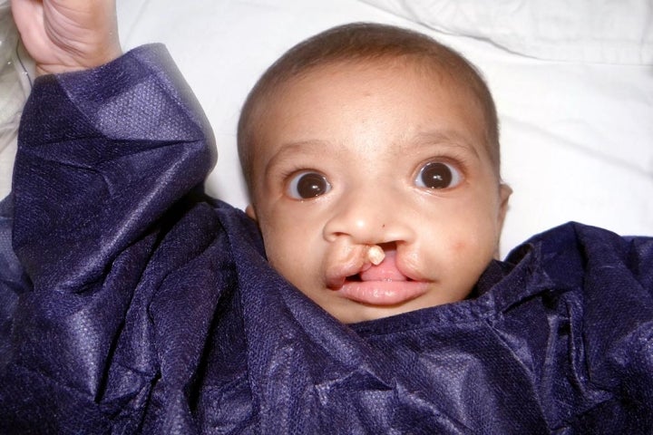 Habeeba before cleft surgery