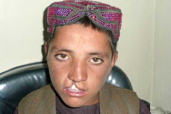 Hekmatullah before cleft surgery