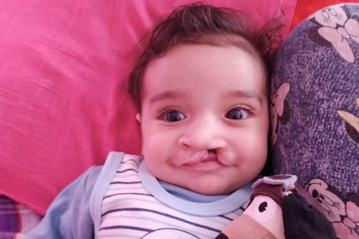 Malek before cleft surgery
