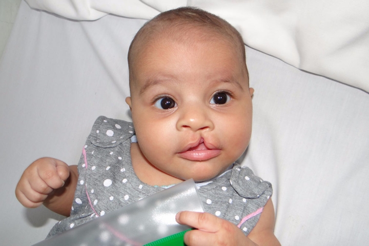 Roaa before cleft surgery