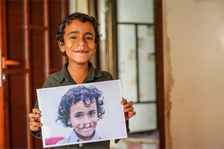 Bilal smiling and holding a picture of himself before cleft surgery