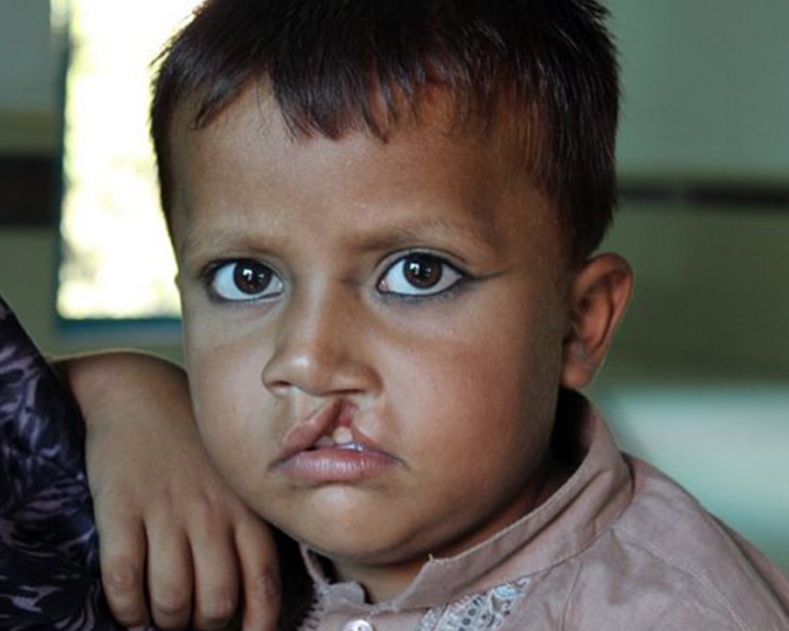 child with cleft lip