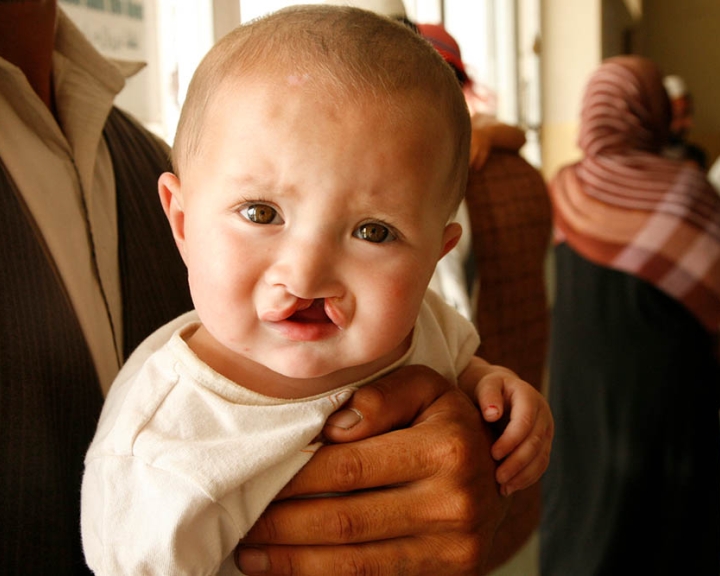 child with untreated cleft lip