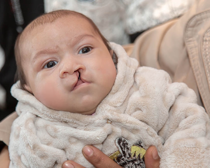 baby with a cleft lip