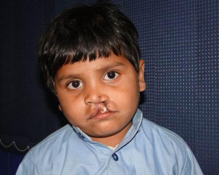 Boy with a cleft lip