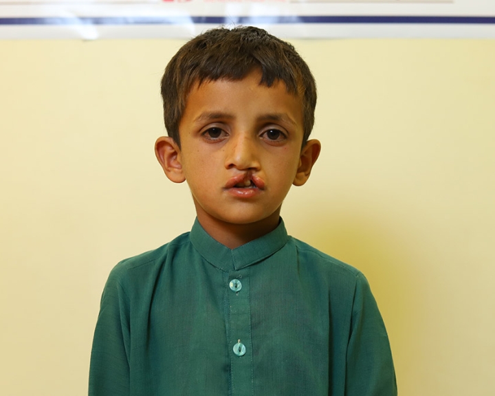 Boy preparing for cleft lip surgery