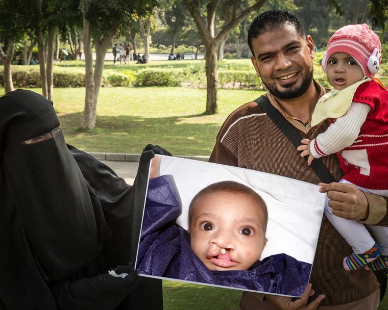 family holds up image of child before cleft lip surgery