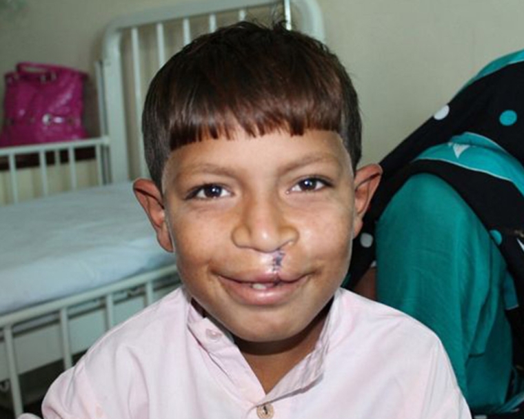 Boy smiles after cleft lip surgery